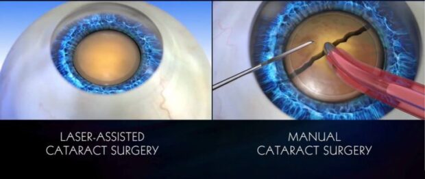 What is the Difference Between Traditional and Laser