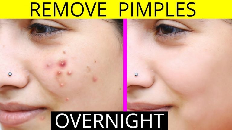 How To Remove Pimples Fast Naturally And Permanently Vel Illum 